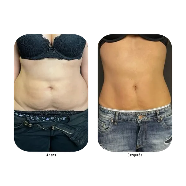 Antes y después — Método Hebe