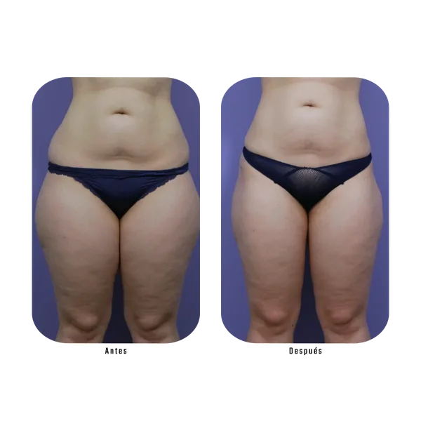 Antes y después — Método Hebe