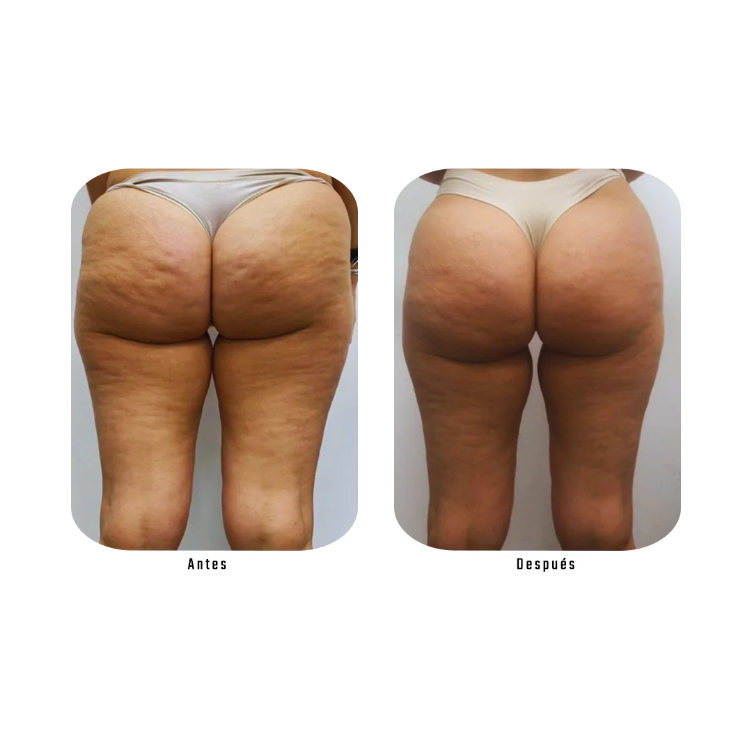 Antes y después — Reducción de celulitis en glúteos con Plan Zero Celulitis, Método Hebe