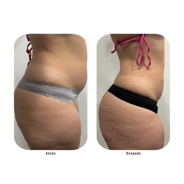 Antes y después — Método Hebe