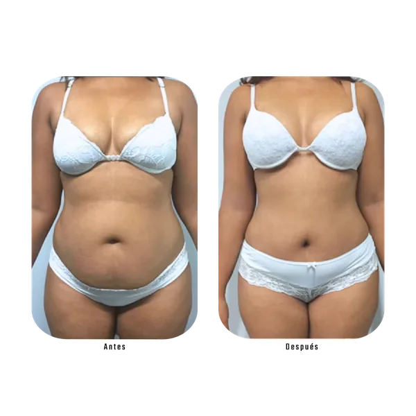 Antes y después — Método Hebe