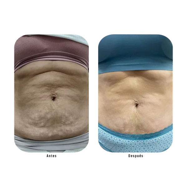 Antes y después — Método Hebe