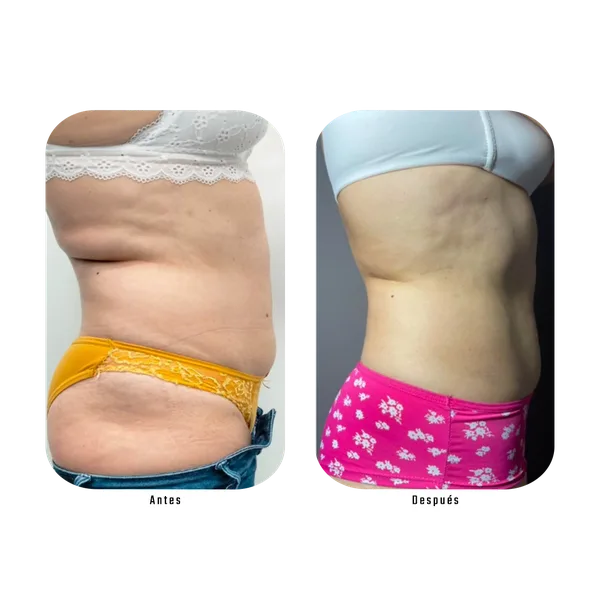 Antes y después — Método Hebe